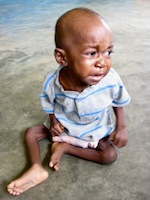 chronic malnutrition